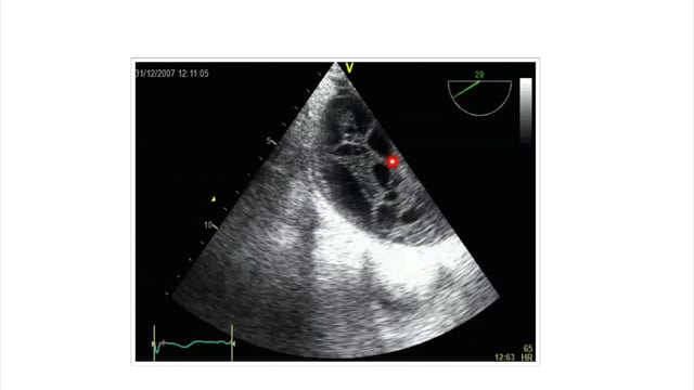 What does a pleural effusion look like in TEE?