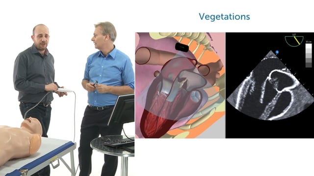 Which views can be used to visualize the aortic valve in TEE?