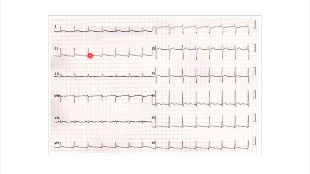 Case: 35 y/o with flu and tachycardia