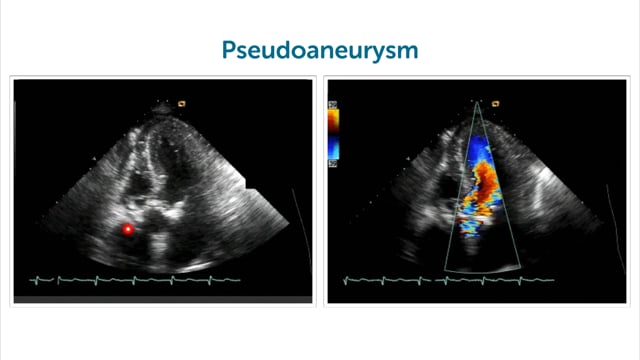 What are the complications of endocarditis?