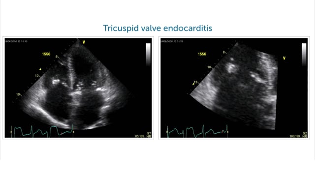 What does endocarditis typically look like?