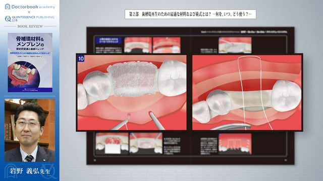 #2 インプラント埋入時解説