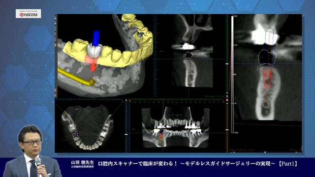 口腔内スキャナーで臨床が変わる！ 〜モデルレスガイドサージェリーの実現〜