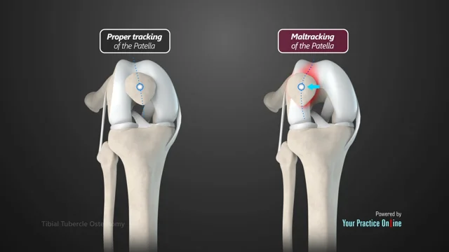 tibial tubercle