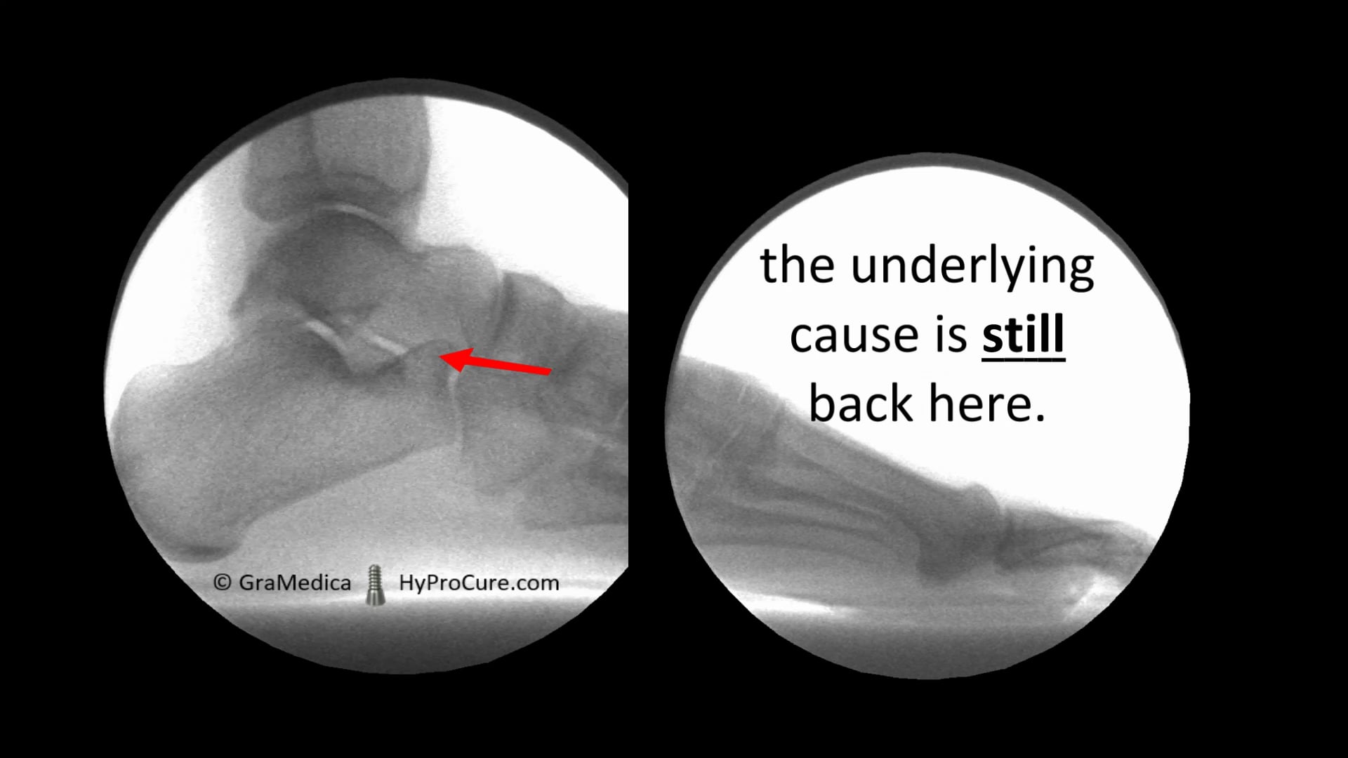 Big toe joint pain Best Treatment on Vimeo