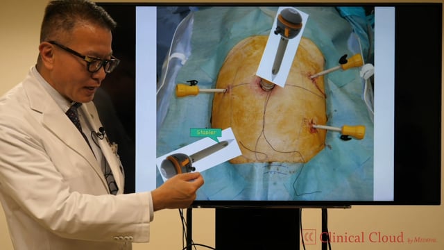 Evolution of Energy System in MIS for ColoRectal Cancer Surgery -Part2-