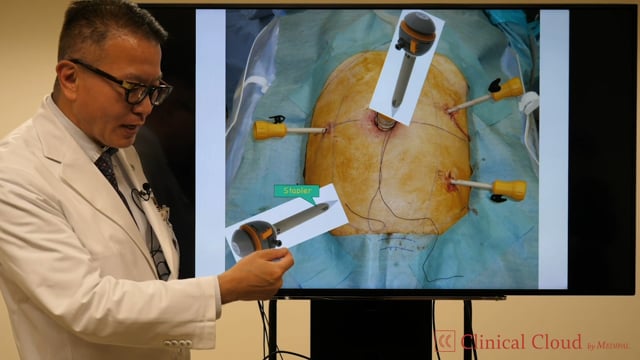 Evolution of Energy System in MIS for ColoRectal Cancer Surgery -Part2-