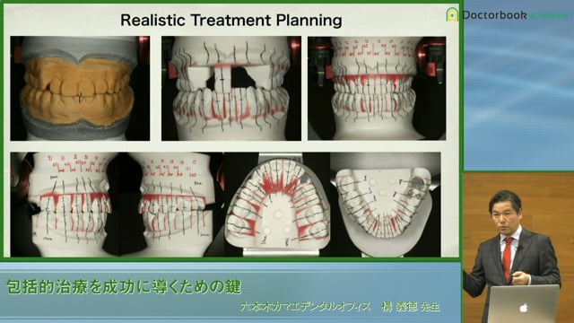 #6 模型上での治療計画