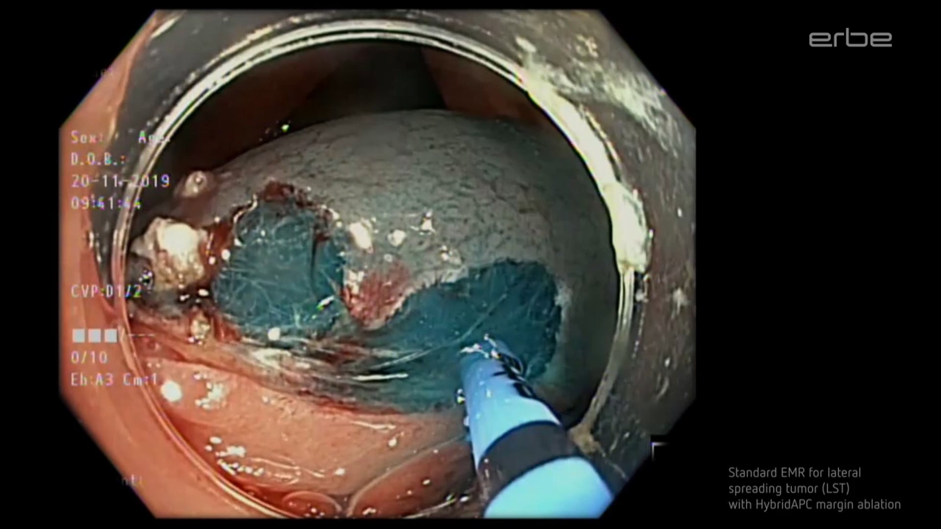 EMR for lateral spreading tumors (LST)  with HybridAPC margin ablation