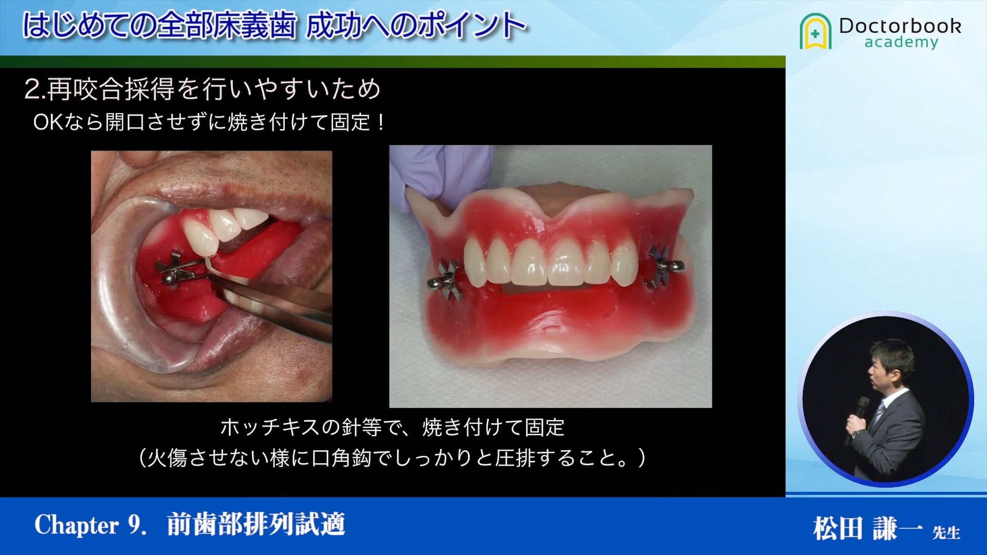 #9 前歯部排列試適