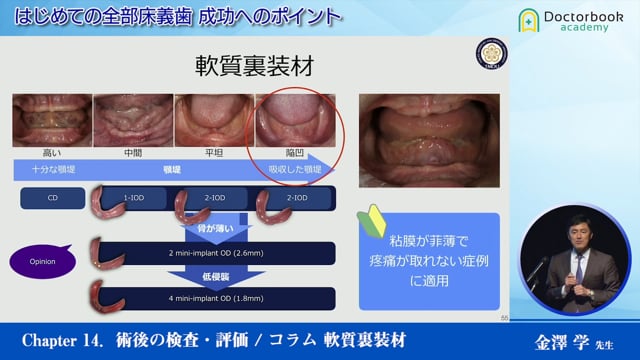 #14 術後の検査・評価 / コラム 軟質裏装材