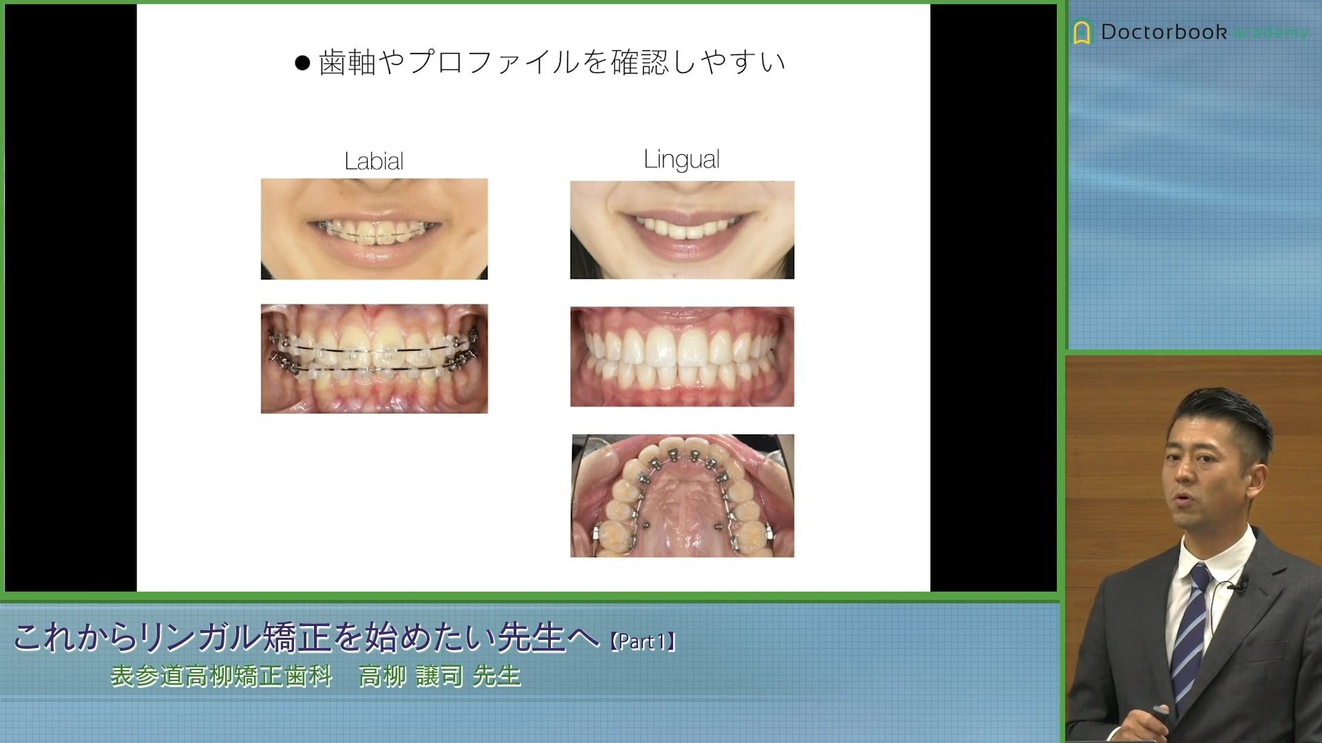 リンガル矯正治療のメリットとデメリット #1