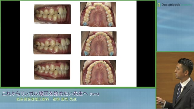 臼歯関係、軽度の叢生非抜歯症例 #5