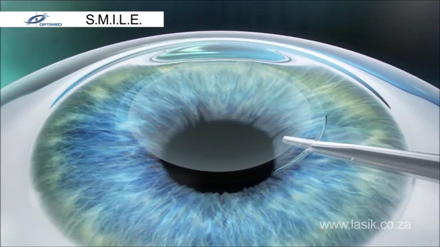 Precision Vision: Custom LASIK Techniques