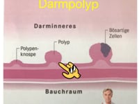 Darmpolyp