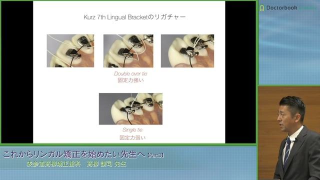 リンガル矯正とラビアル矯正の違い、ブラケットの実際の装着脱方法 #3