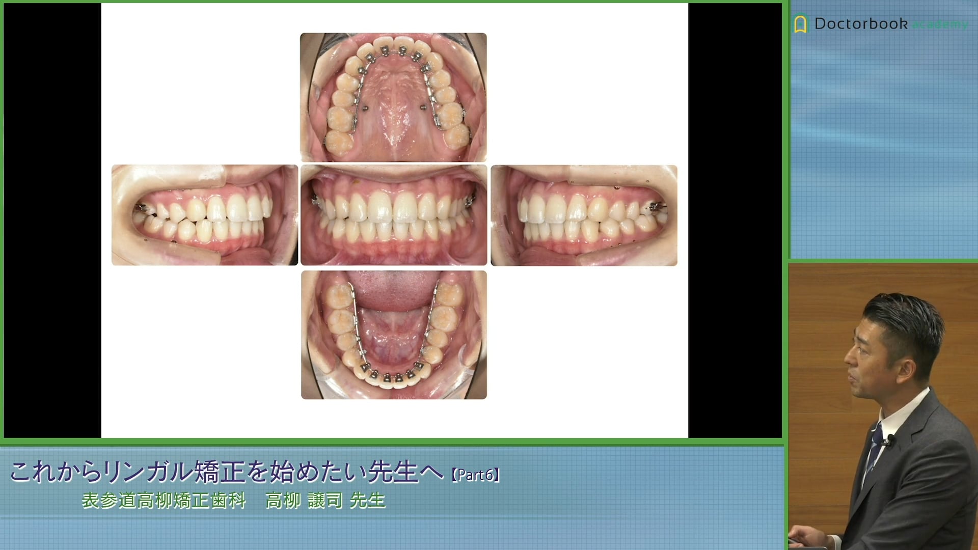 軽度の非抜歯症例、Ⅱ級上顎片顎抜歯症例 #6