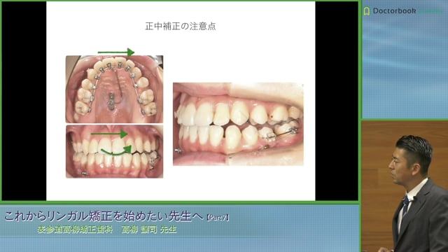 Ⅱ級上顎片顎抜歯症例、Ⅰ級上下顎抜歯症例（ハーフリンガル）、 SkeletalⅢ Angle ClassⅡ 難症例 #7
