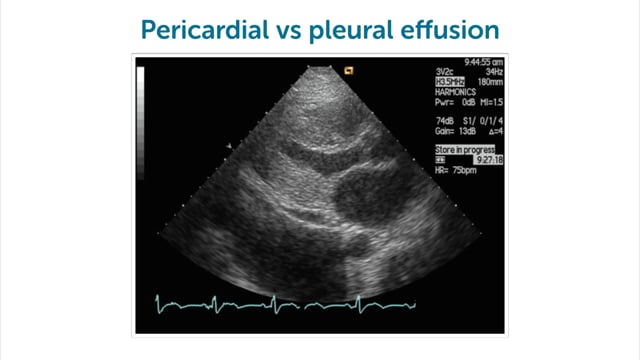 Why should I look for pleural effusion when doing an echo?