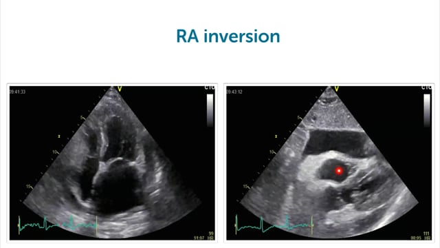 What is cardiac tamponade?