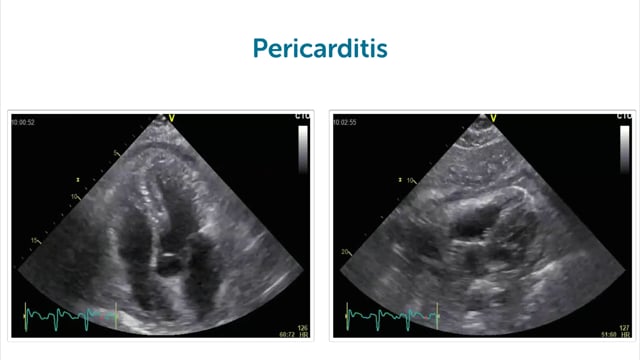 When does a pericardial effusion matter?