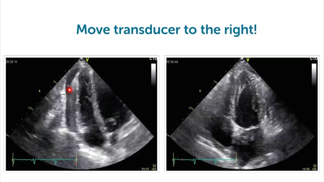 How can I image a pericardial effusion with ultrasound?
