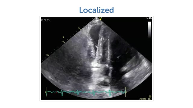 Why can pericardial effusions be localized?