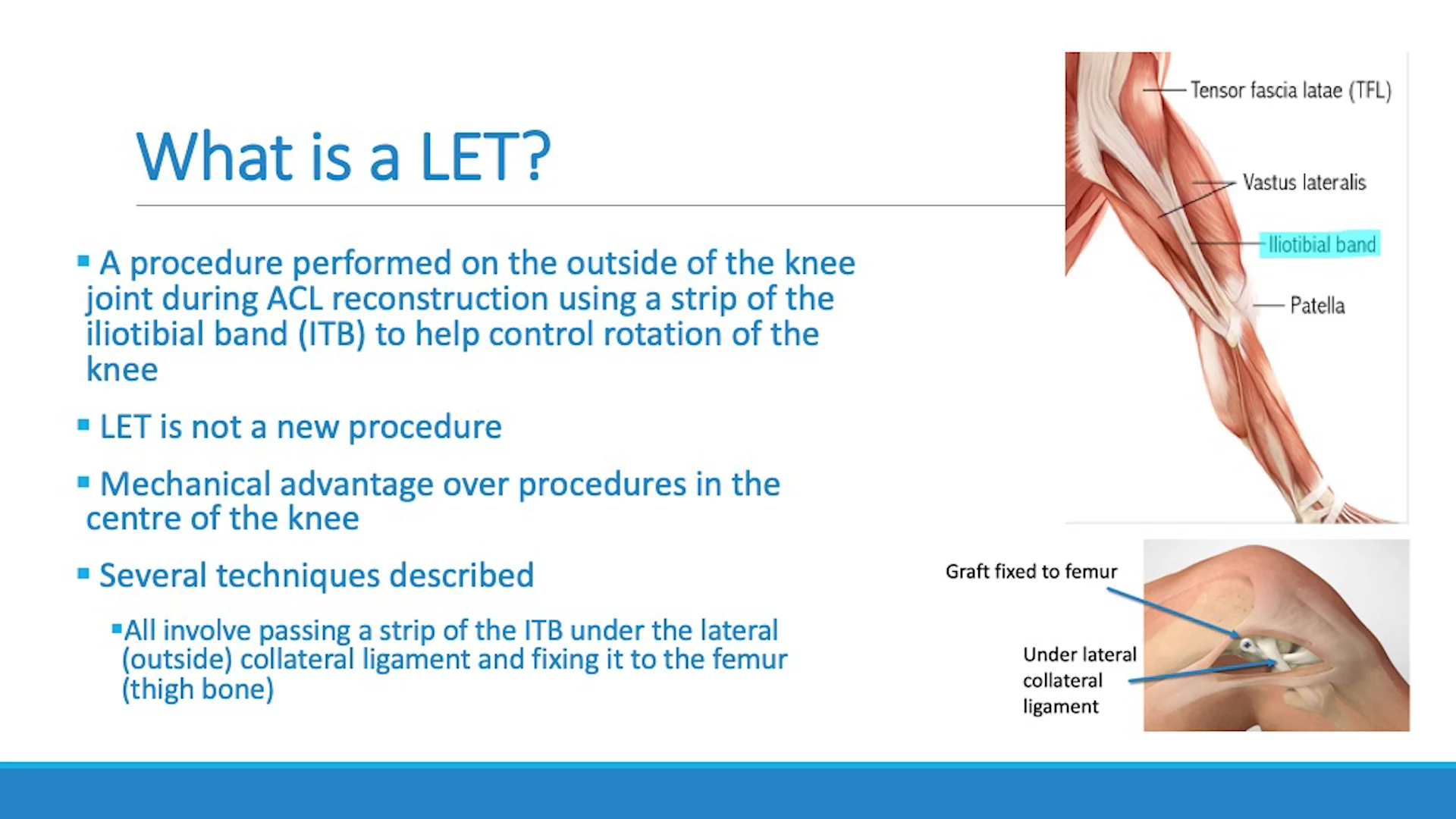 Iliotibial Band Tenodesis, ACL Surgery, ITB Tenodesis, Orthopedic Knee  Surgeon
