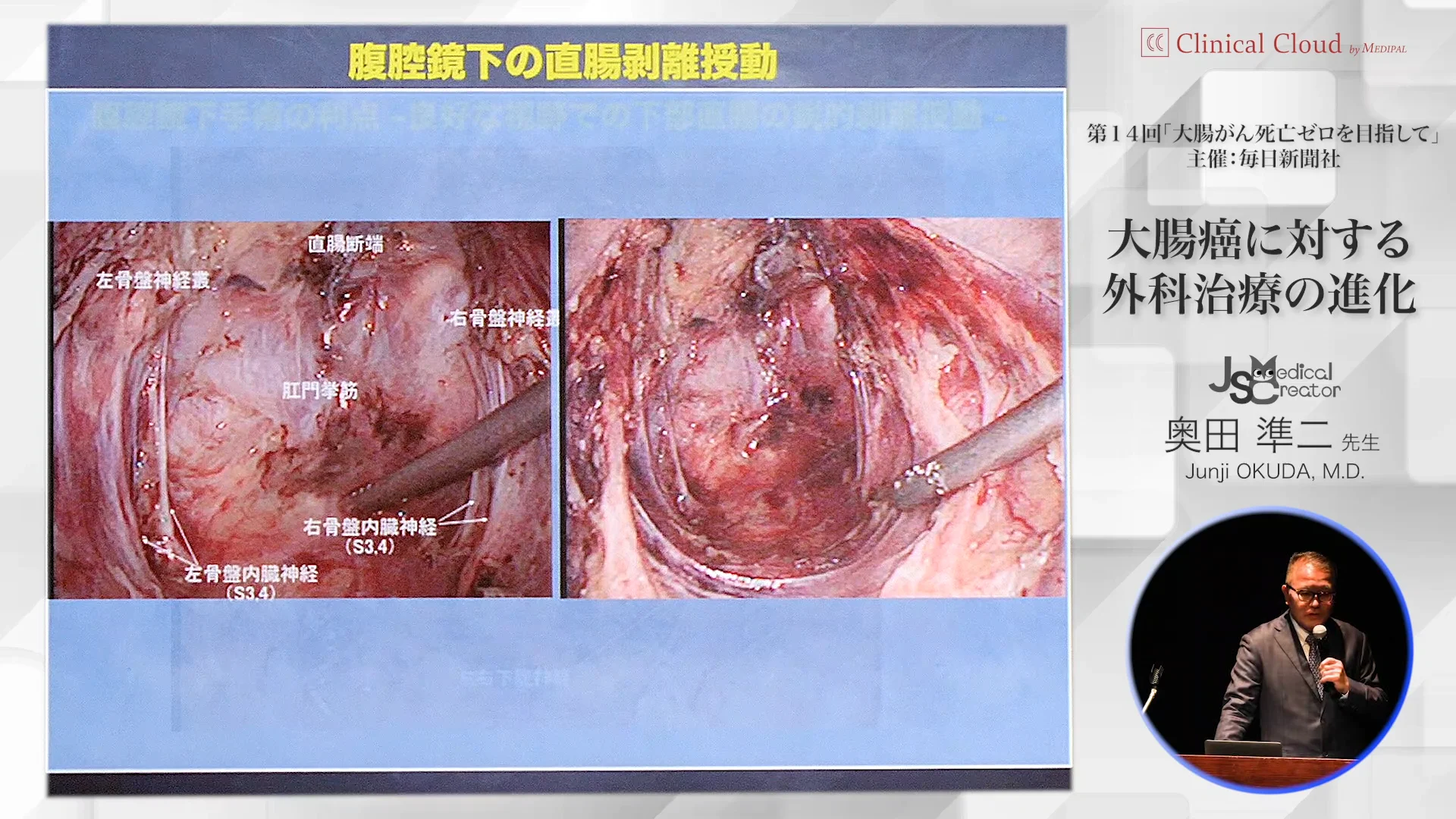 腹腔鏡下大腸癌手術 発生からみた筋膜解剖に基づく手術手技