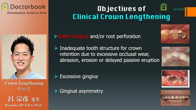 Crown Lengthening