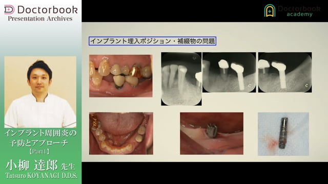 #1 インプラント周囲炎と歯周炎の細菌叢