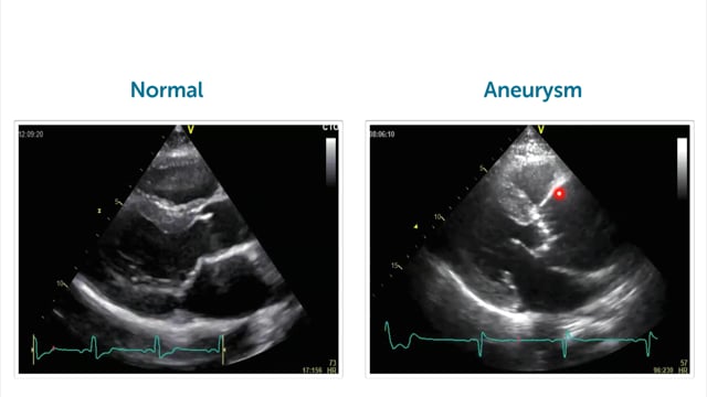 What does a dilated aorta look like in echocardiography?