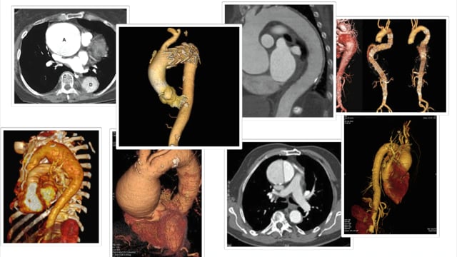 What imaging modality should I use for the aorta?