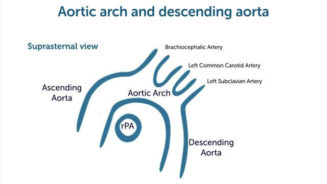 How to image the aortic arch with echocardiography