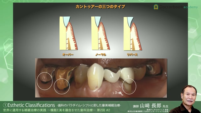 #2 Esthetic Classifications -歯科のパラダイム・シフトに即した審美補綴治療-