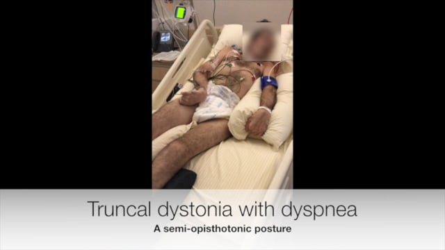 dystonia hipertónia tachycardia szív egészségének és keringésének folyóirata