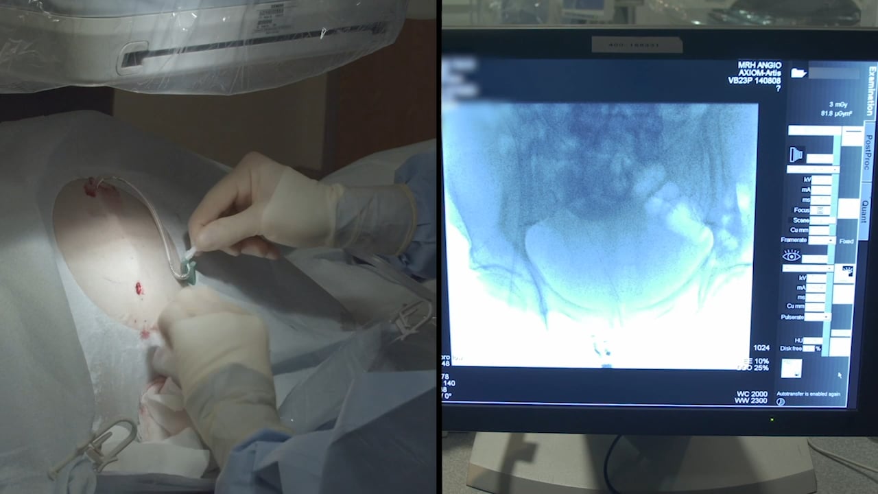 Aspira Drainage System Insertion of a Peritoneal Catheter on Vimeo