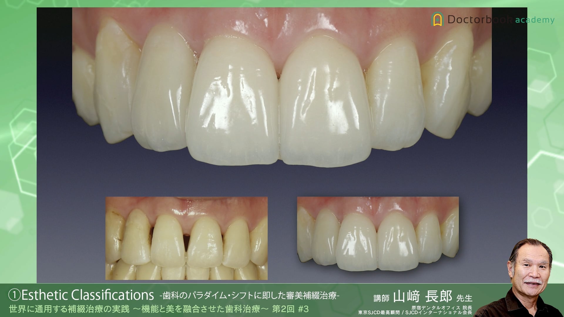 #3 Esthetic Classifications -歯科のパラダイム・シフトに即した審美補綴治療-