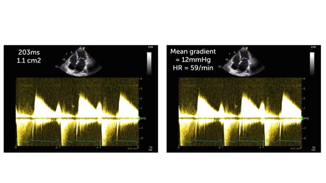 How can I quantify MS based on the mean gradient?