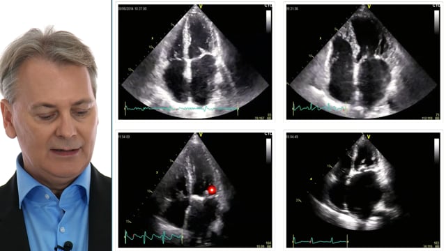 How can I find good candidates for mitral valvuloplasty?