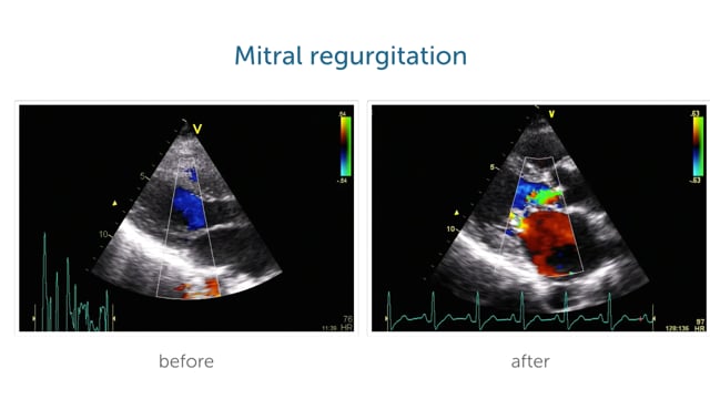 How should I follow up patients after valvuloplasty?