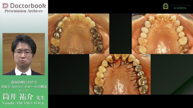 歯周治療における炎症と力のコントロールの概念