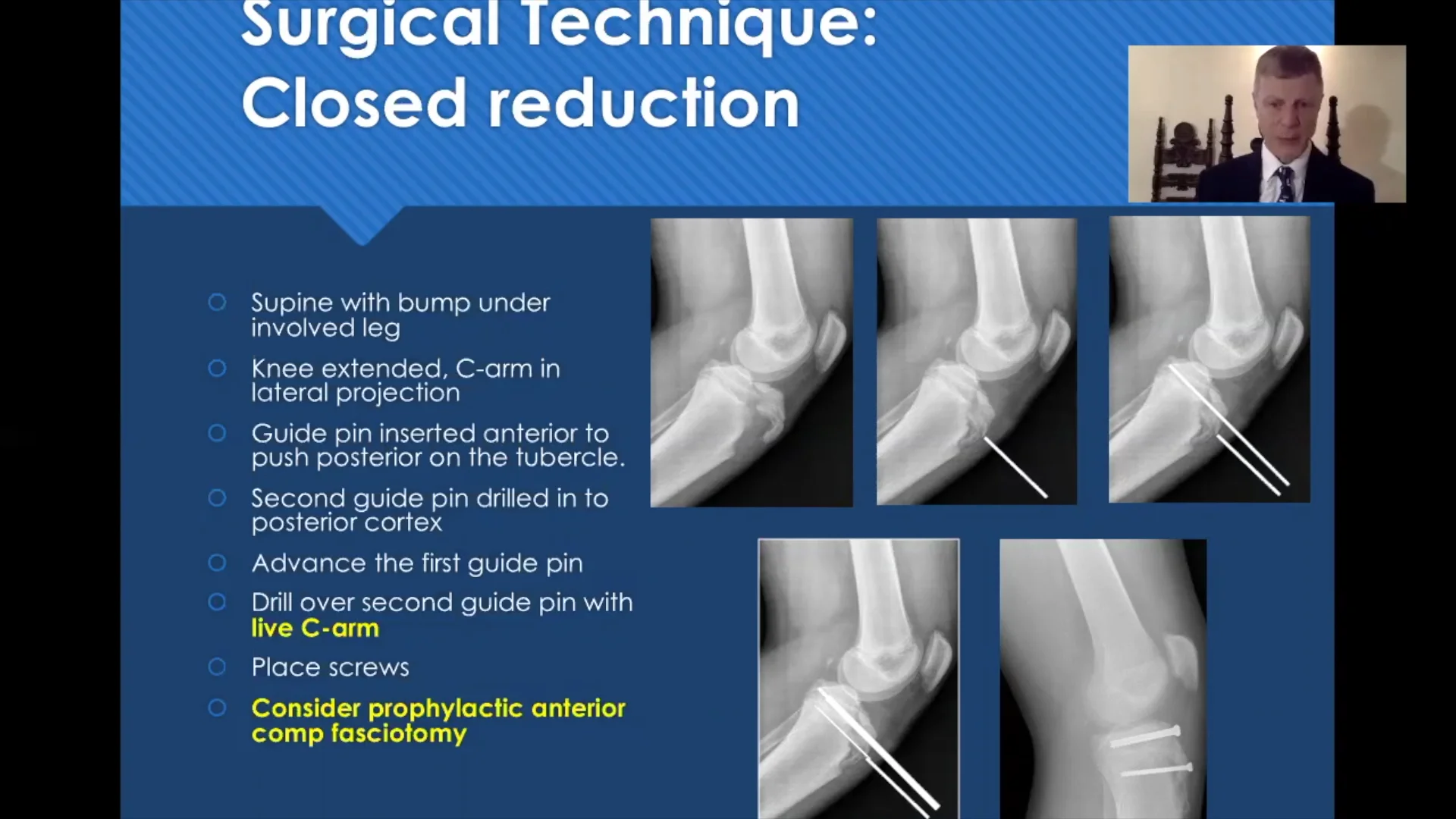 Closed Reduction in the Treatment of Tibial Tubercle Fractures