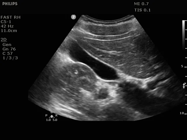 gallbladder ultrasound transverse