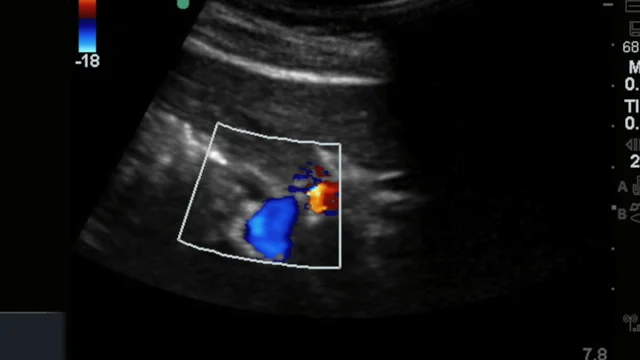 Chronic Cholecystitis Ultrasound Wes Sign