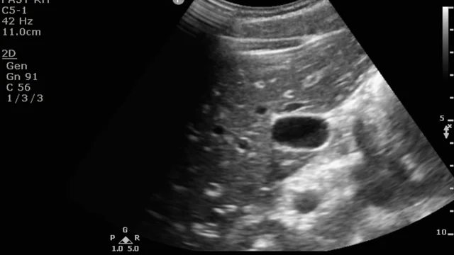 Gallbladder Anatomy Ultrasound