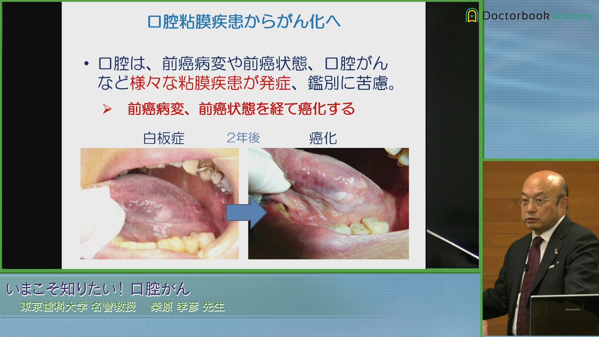 口腔がんは歯科で診るべき？口腔粘膜疾患からがん化へのプロセスと多段階発がん機構 #2