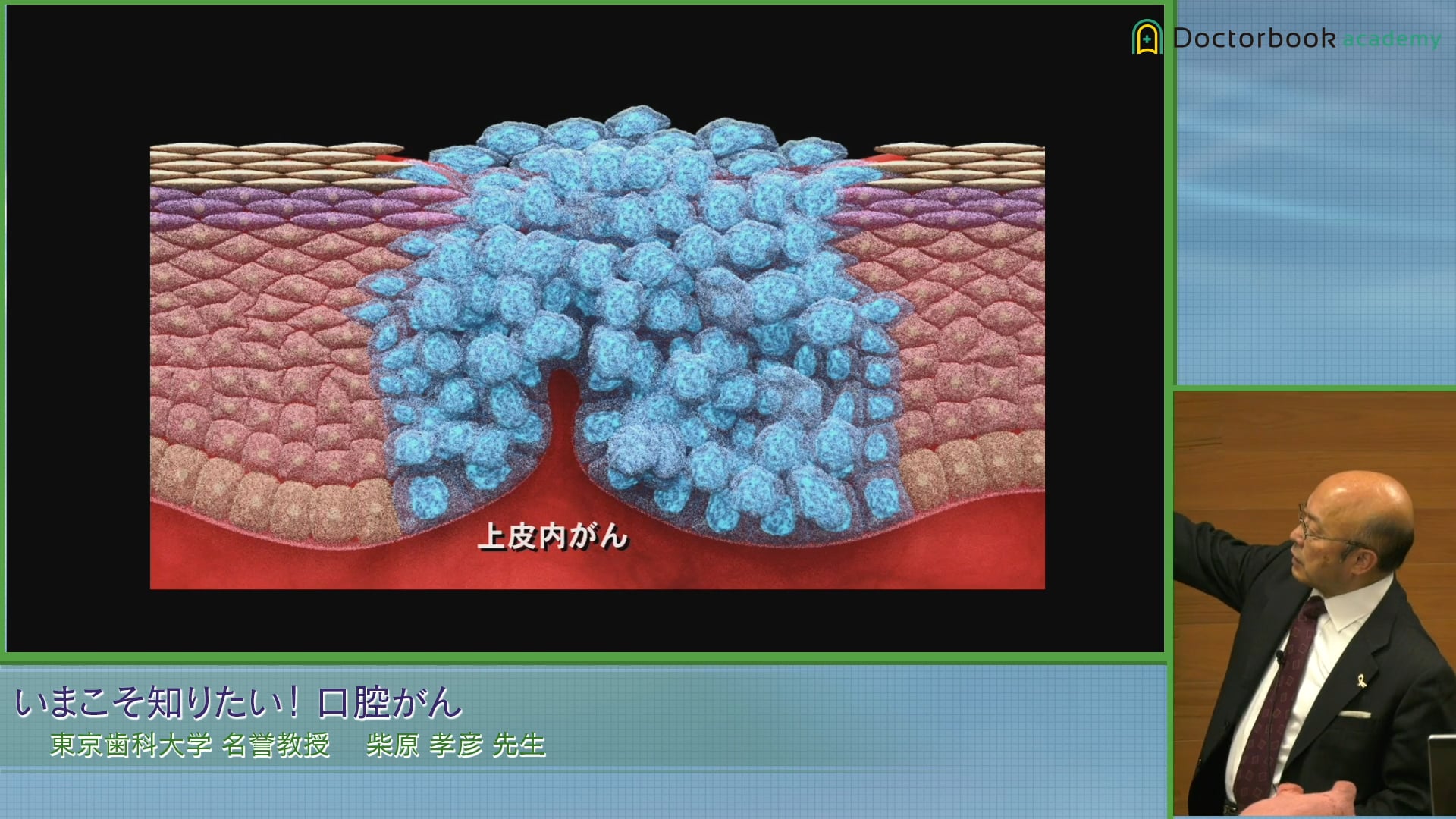 口腔がんの治療とは？原発部別のStage分類とリスク因子 #3