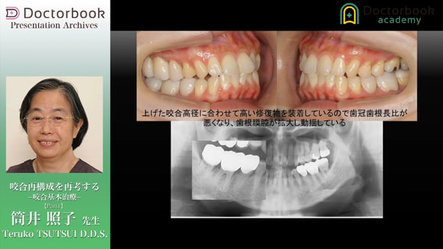 咬合再構成を再考する - 咬合基本治療 -