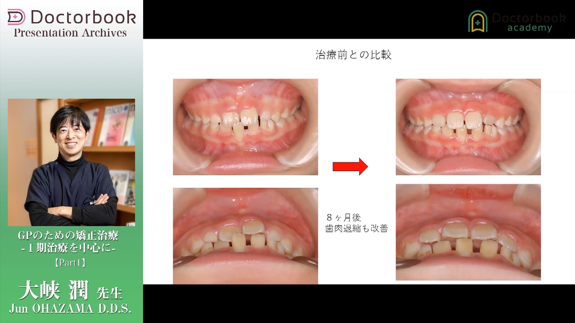 ホームドクターによる小学校2年生までに始める拡大床治療 - 健康・医学